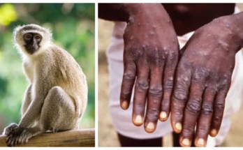 Monkeypox Outbreak Emergency 